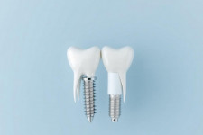 Имплантация зубов в Перми: как не потеряться в выборе и получить надежный результат