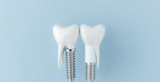 Имплантация зубов в Перми: как не потеряться в выборе и получить надежный результат