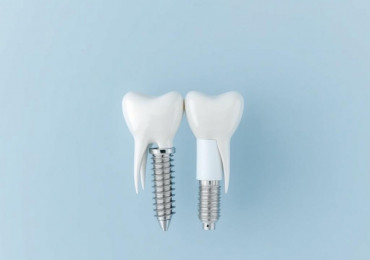 Имплантация зубов в Перми: как не потеряться в выборе и получить надежный результат