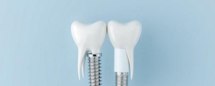 Имплантация зубов в Перми: как не потеряться в выборе и получить надежный результат