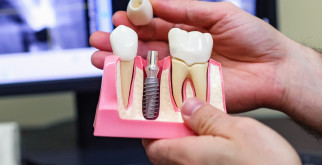 Имплантация зубов: показания, противопоказания и выполнение