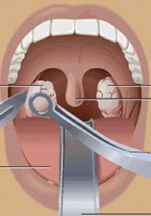 Метаболический ацидоз: что это такое у взрослых и как с этим справляться