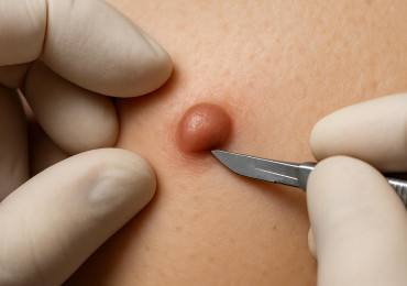 Удаление фибромы: методы лечения, диагностика и цена процедуры