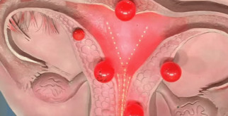 Лечение эндометриоза матки: что нужно знать
