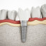 Имплантация зубов: первоклассное решение с помощью процедуры ‘под ключ’