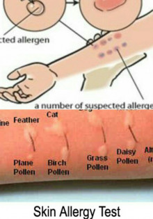Как пройти обследование на аллергию?