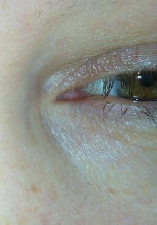 Синовит плечевого сустава: что это такое и как с этим бороться