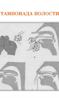 Что такое тампонада носа при кровотечении?