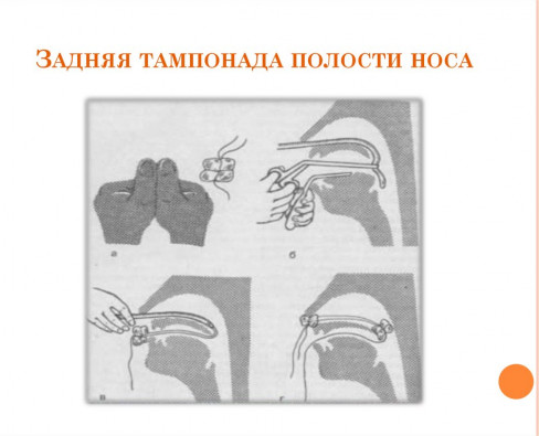 Что такое тампонада носа при кровотечении?