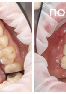 Революционные методы имплантации зубов: встречайте современные технологии!