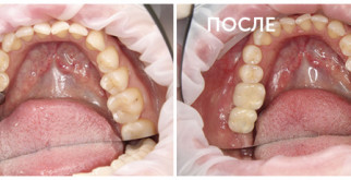 Революционные методы имплантации зубов: встречайте современные технологии!