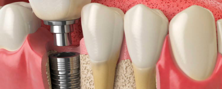 Кому показана имплантация зубов?