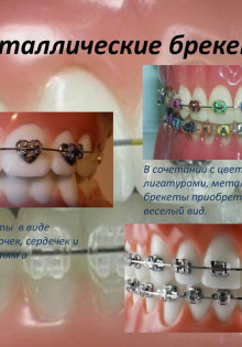 Дисплазия соединительных тканей: что это и как с этим жить