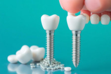 Имплантация зубов «под ключ» в Москве: цена, этапы, сроки
