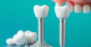 Имплантация зубов «под ключ» в Москве: цена, этапы, сроки
