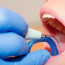 Профессиональная гигиена полости рта в стоматологии: плюсы