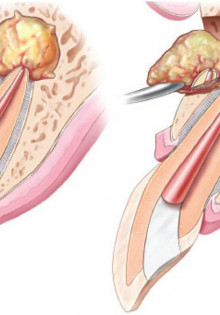Как лечится киста зуба?