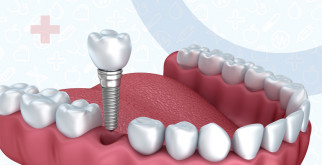 Современные способы имплантации зубов