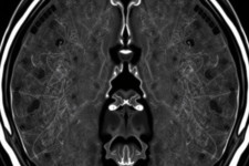 МРТ отделов позвоночника: понятный гид для тех, кто собирается на исследование