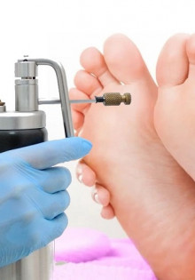 Способы удаления мозолей