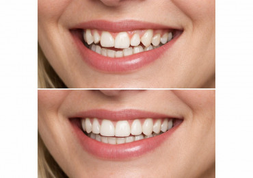 Исправление прикуса: что важно знать, чтобы не пожалеть о выборе