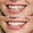 Исправление прикуса: что важно знать, чтобы не пожалеть о выборе