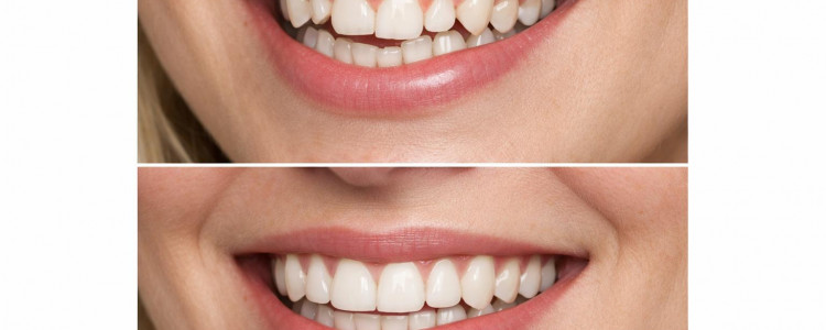 Исправление прикуса: что важно знать, чтобы не пожалеть о выборе