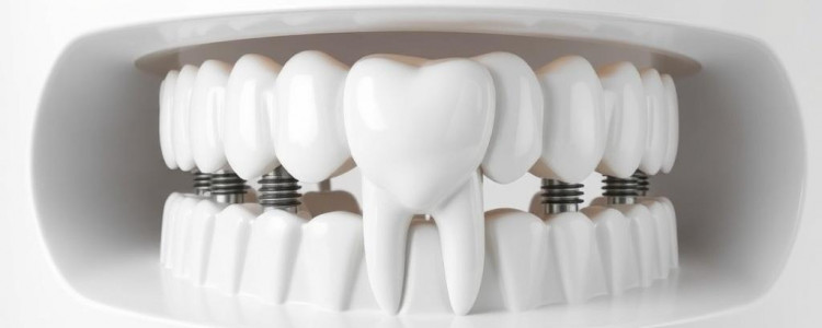 Имплантация зубов в Уфе: возвращаем улыбку без лишней суеты