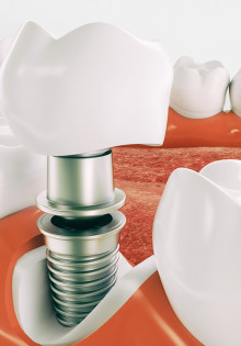 Особенности протезирования зубов в рассрочку