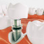 Особенности протезирования зубов в рассрочку