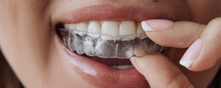 Элайнеры для зубов: особенности использования