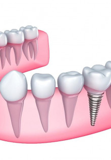 Спондилолистез пояснично-крестцового отдела позвоночника: что это такое и как его лечить