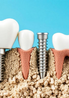 Зубные импланты: стоит ли ставить и с чем придется мириться