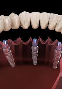 Что такое протезирование на имплантах?