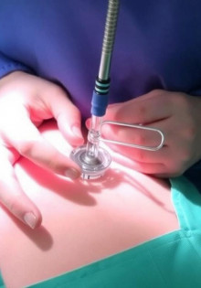 Установка цистостомы: как проходит процедура