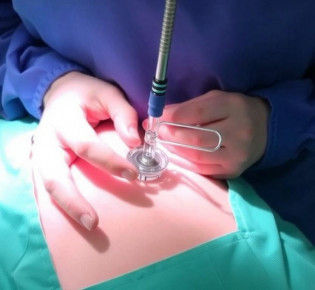 Установка цистостомы: как проходит процедура