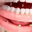 Как протезировать зубы?