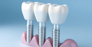 Имплантация зубов: как вернуть улыбку без компромиссов
