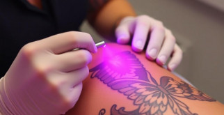 Лазер для удаления татуировок и татуажа: что реально работает и чего ожидать