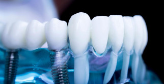 Всё, что нужно знать о процедуре установки дентальных имплантов