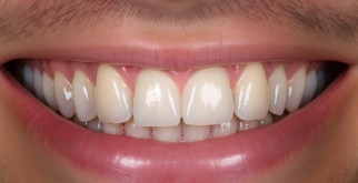 Виниры на зубы: преображение улыбки, доступное каждому