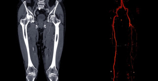 Ангиография нижних конечностей: преимущества, процедура и рекомендации