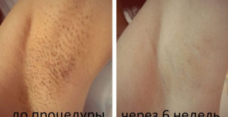 Лазерная эпиляция: эффективный и безопасный способ избавиться от нежелательных волос