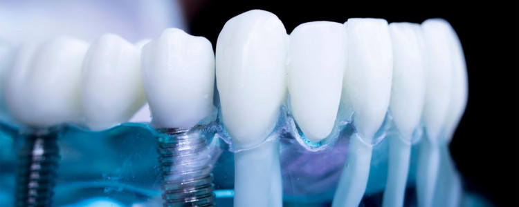 Что необходимо для имплантации зубов