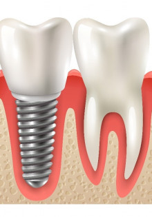 Все, что нужно знать о процедуре установки дентальных имплантов