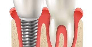 Все, что нужно знать о процедуре установки дентальных имплантов