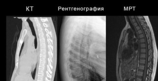 Кифоз позвоночника: что это такое и как с этим справиться