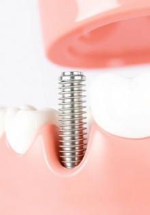 Имплантация зубов: что это, как проходит и почему стоит знать больше, чем из рекламы