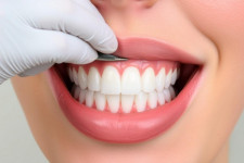 Установка виниров: что нужно знать прежде чем менять улыбку