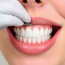 Установка виниров: что нужно знать прежде чем менять улыбку